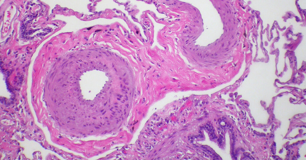 Pulmonary arterial pulmonary hypertension